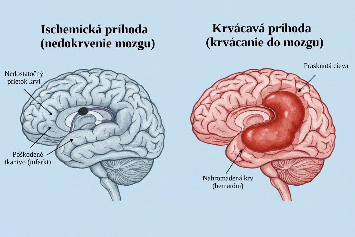 Dva obrázky mozgu. Jeden nedokrvenie mozgu pre uchatú cievu. Druhý s prasknutou cievou s krvácaním do mozgu.